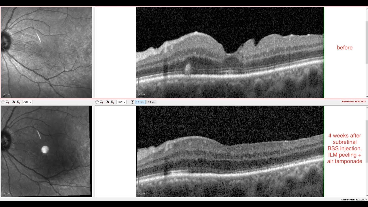case report retinal macrofolds after retinal detachment surgery YouTube