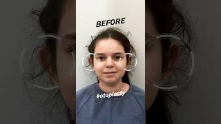 Otoplasty Surgery (Ear Pinning) #earsurgery