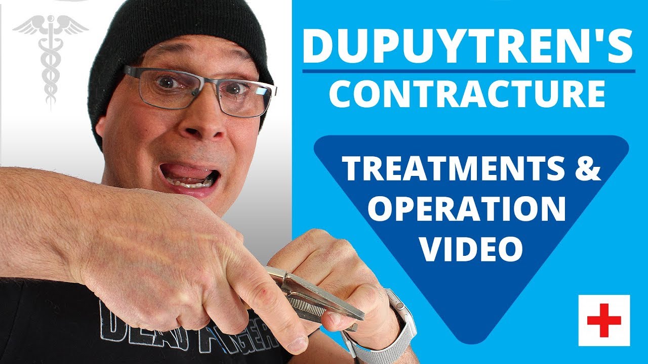 Dupuytren's Contracture Treatments & Operation Video (2018) YouTube