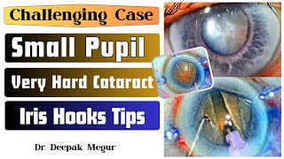 Challenging Case Small Pupil Very Dense Cataract And Tips For Iris Hooks - Dr Deepak Megur