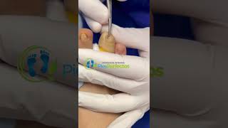 Matricectomia en dedo pequeño #ingrown_toenail_surgery