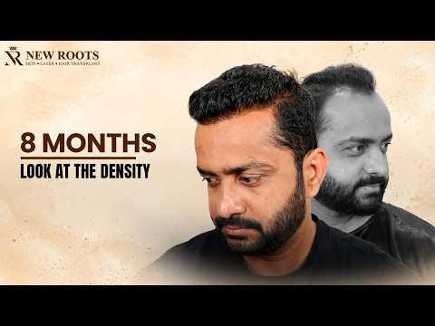 Natural Hair Growth After Hair Transplant! 😍 | Hair Transplant in Kolhapur | Cost & Best Results
