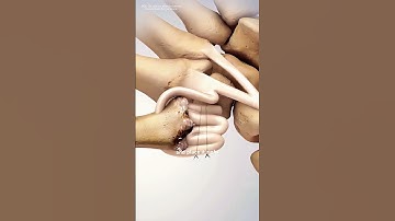 How A Tendon Can Replace Trapezium Bone In Thumb Arthritis?(3D animation) #tendonrupture #tendon