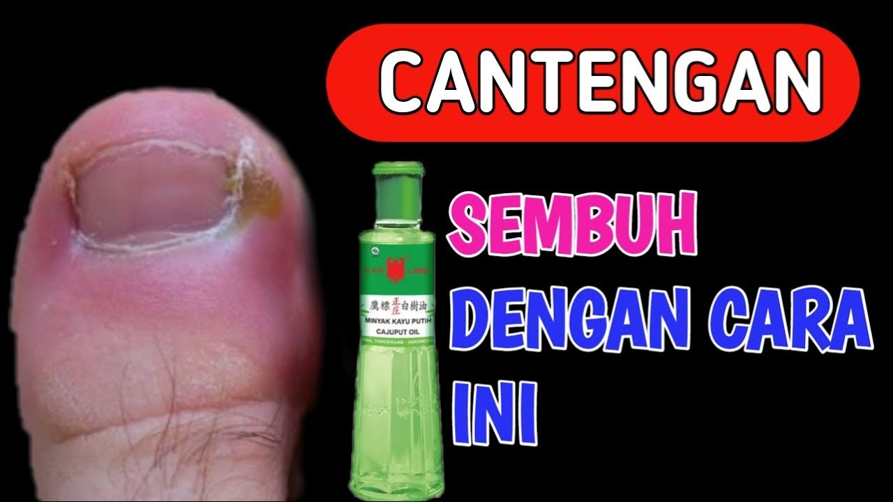 Telah Ditemukan!! Obat Cantengan Di Jempol kaki | Keluarga Sehat Alami