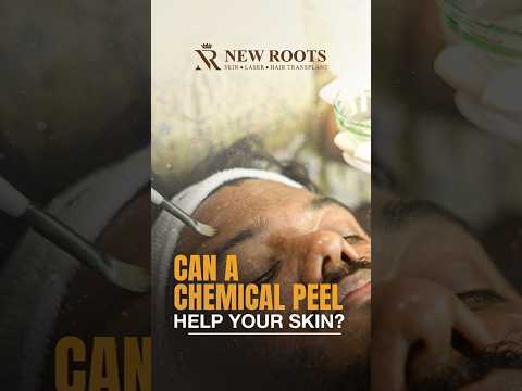 Want Clearer, Brighter Skin? Chemical Peel Explained #skin #shorts