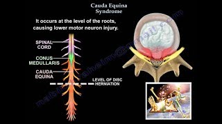 Cauda Equina Syndrome - Everything You Need To Know - Dr. Nabil