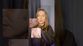 а вы знали? #постакне #акне #пигментация  #ретинол #витаминс #сухостькожи #pdrn  #уходзажирнойкожей