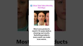 I Spent ₹5000 on Acne Products Before Realizing THIS Was Causing My Acne 😳#skincare #viralshorts