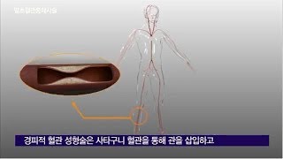 Peripheral Vascular Intervention