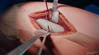 QuickPass™ FiberTape® Cerclage System