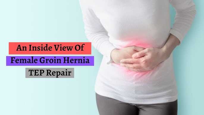 An Inside View Of Female Groin Hernia TEP Repair 