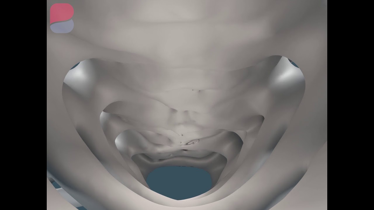 Дегенеративный стеноз позвоночного канала - YouTube