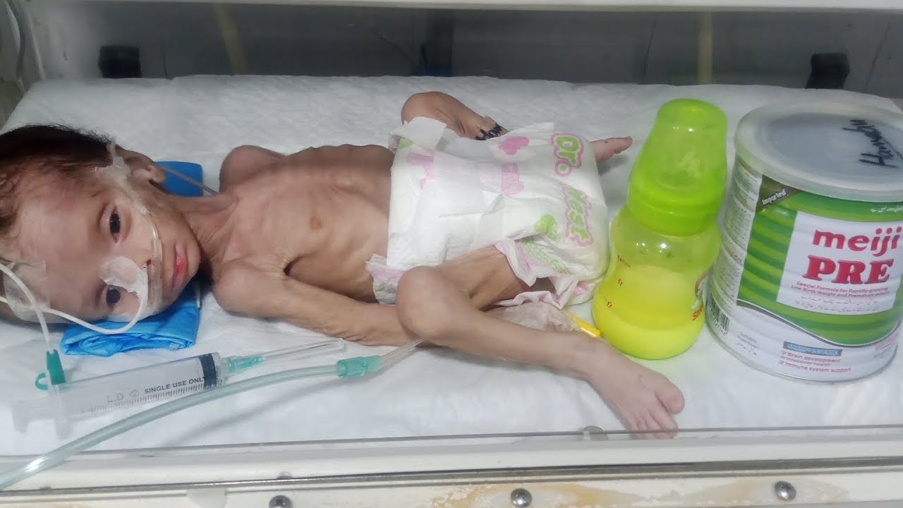 Part Seven | Premature Baby NG Tube Feeding Paper Feeding Method in NICU, Slow Progress Strong 🍼🍼