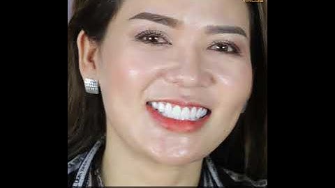 Vincos khắc phục răng sứ bọc sai cách cho khách hàng và điều trị cười hở lợi chỉ với 30 phút!