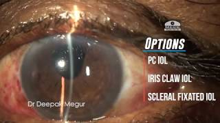 Secondary IOL implantation in an aphakic eye with PC tear & vitreous prolapse- Dr Deepak Megur