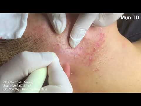Video Mụn siêu nhiều trên bề mặt da. Hotline: 0911.522.662 - youtube