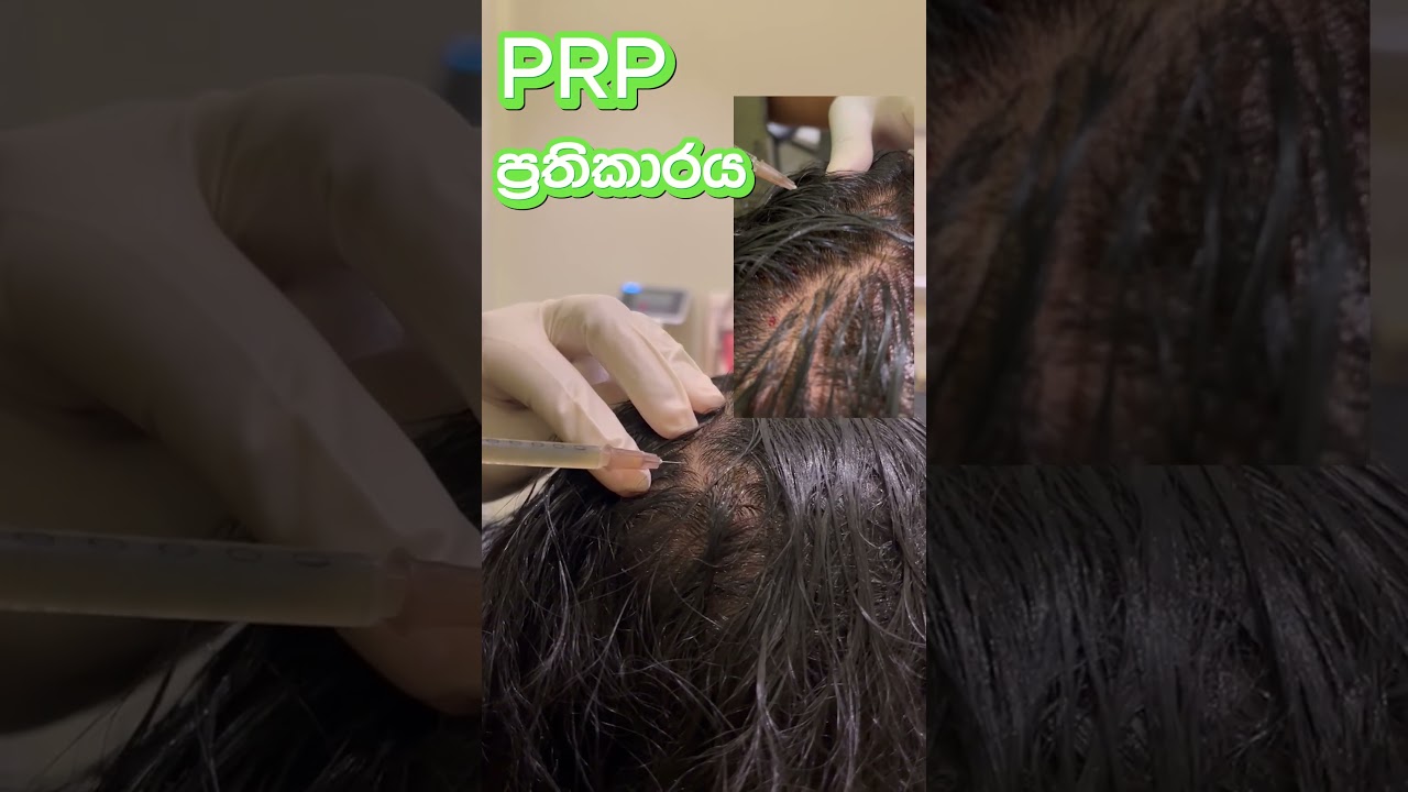 PRP Treatment in Sri Lanka | Dr Nayani Madarasinghe