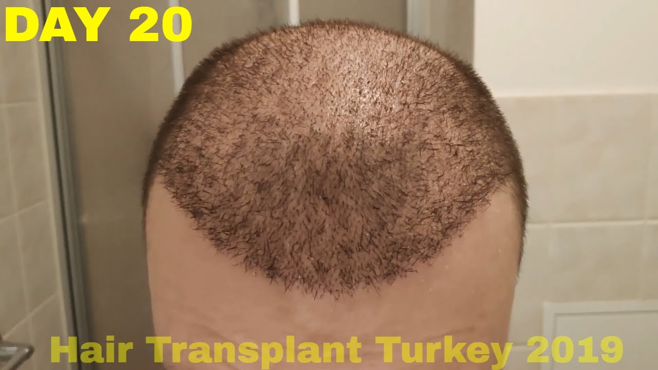 Affordable and Best FUE Hair Transplant  La Densitae