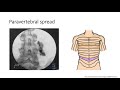 paravertebral lecture- audio.mp4