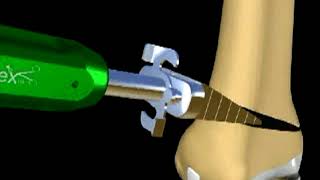 Distal Femoral Osteotomy to correct a valgus knee
