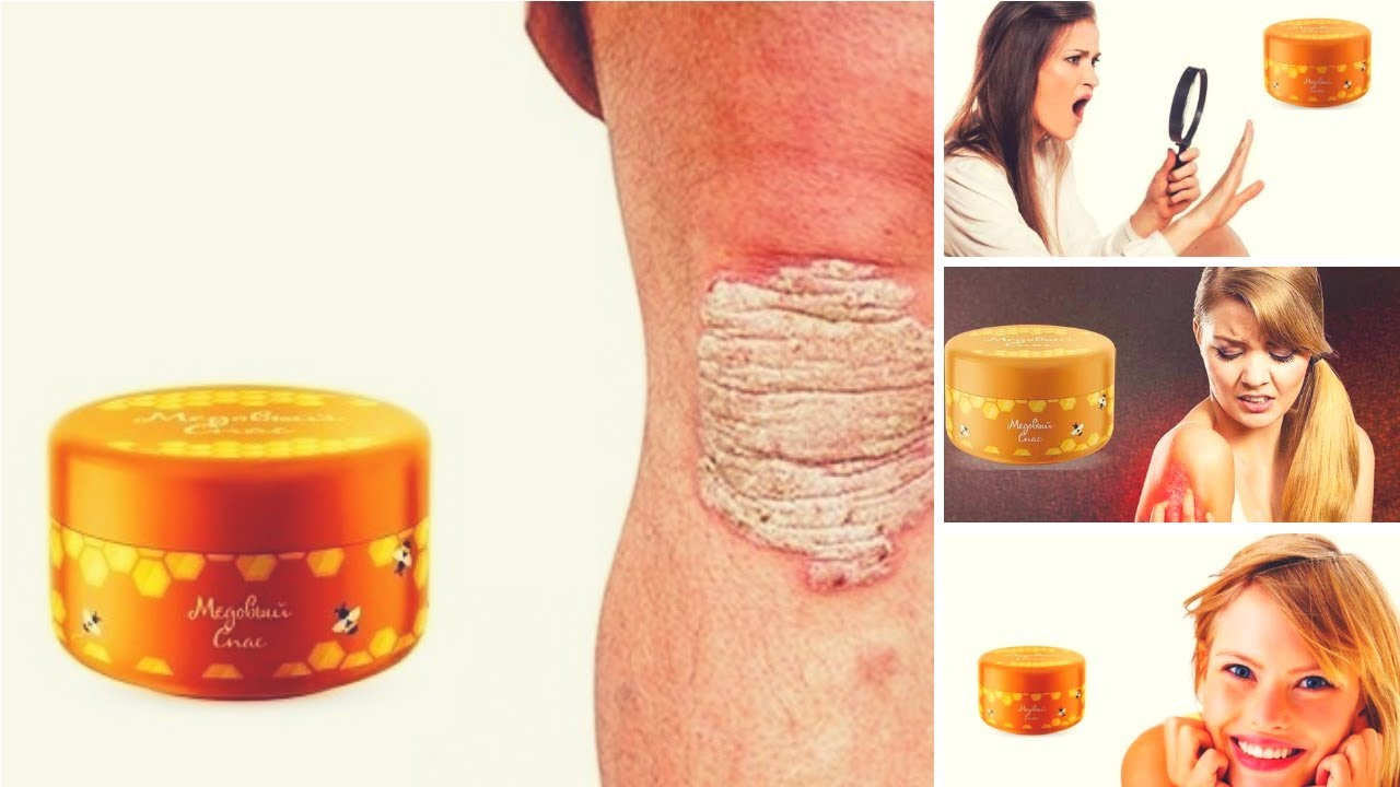 Эффективное средство от псориаза Медовый спас