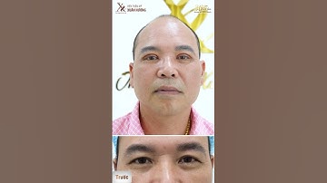 Kết Quả Cắt Mí Mắt Sau 5 Ngày Cắt Chỉ Tại VTM Xuân Hương