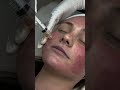 PRP Microneedling at Darlings Beauty Lab