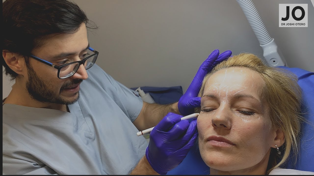 Cuanto Botox se coloca en el rostro?