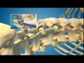 XLIF / DLIF Minimally Invasive Spine Surgery for Back Pain Animation - Dr. Neel Anand