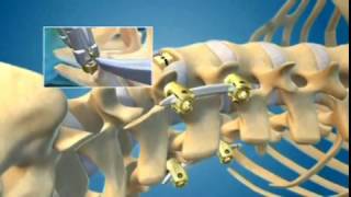 XLIF / DLIF Minimally Invasive Spine Surgery for Back Pain Animation - Dr. Neel Anand