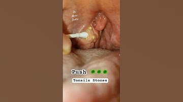 Remove the tonsils Stones