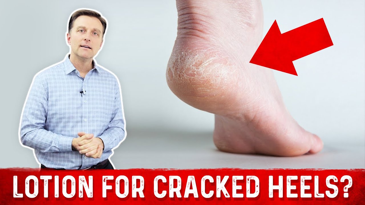 Foot care; Why you have hard, dry and cracked feet