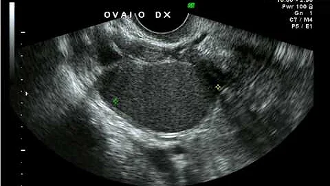 Come capire se si ha una ciste endometriosica?