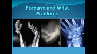 Forearm and Wrist fractures
