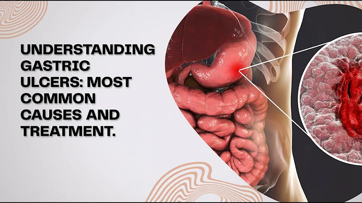 Gastric Ulcers Explained | Causes, Symptoms & Treatment