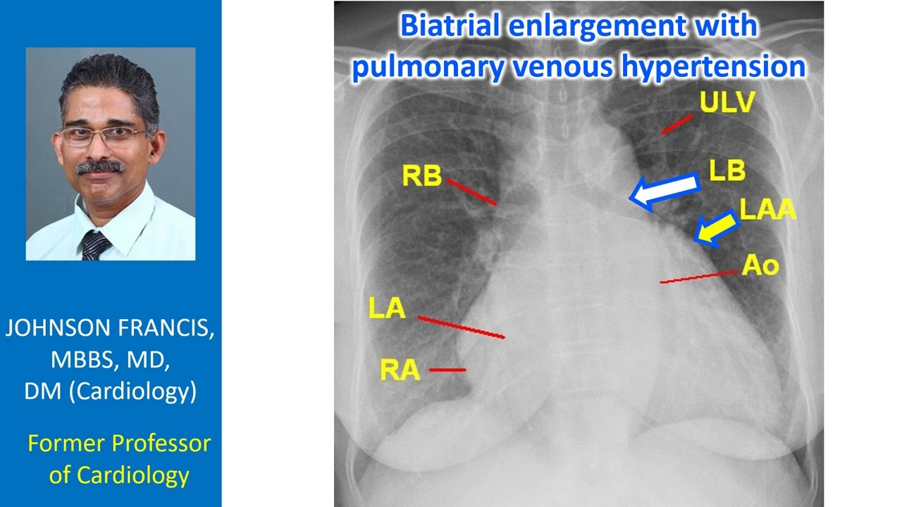 Biatrial enlargement with pulmonary venous hypertension