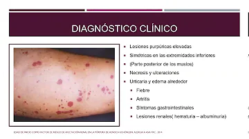 ¿La púrpura significa leucemia?