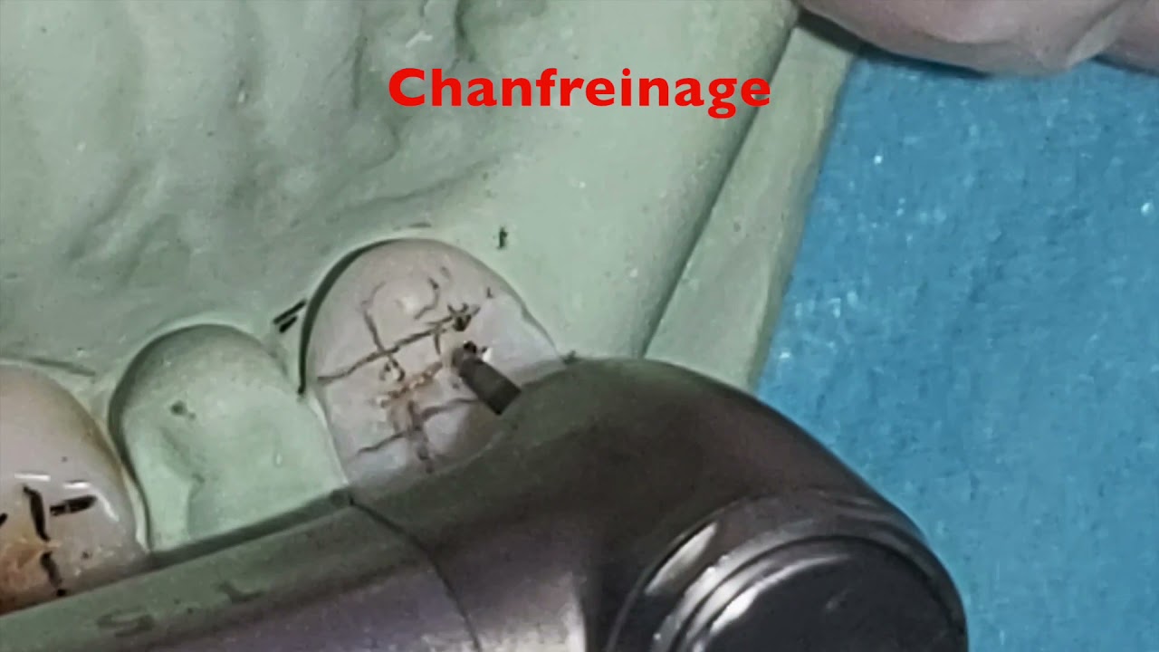 Améloplasties en PAP métallique parti 1 : Réalisation des appuis occlusaux