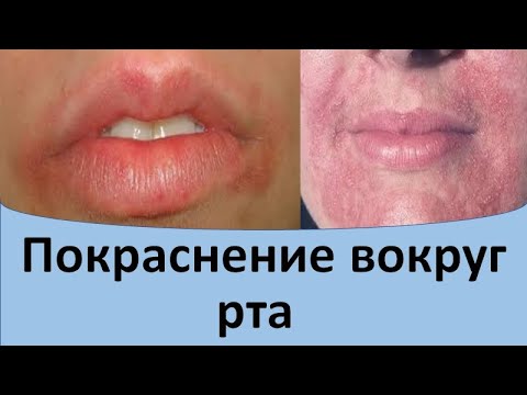 Видео: Почему шелушится кожа во рту?