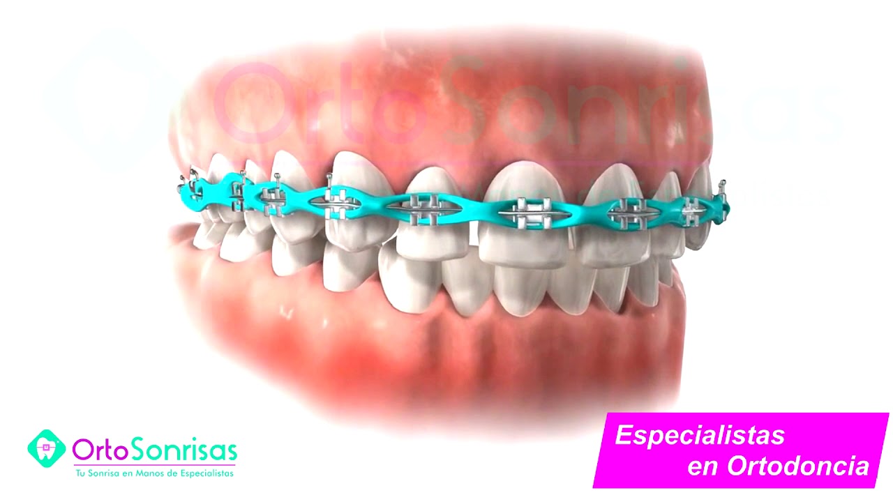 Brackets 3D Cadena de Ortodoncia Ortosonrisas Barranco YouTube Brackets 3D Cadena de Ortodoncia Ortosonrisas Barranco YouTube