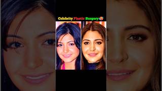 Celebrity Plastic Surgery Fails 😱 Before vs After #shorts
