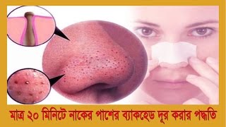 মাত্র ২০ মিনিটে নাকের পাশের ব্ল্যাকহেড দূর করার পদ্ধতি  bangla health tips for men in women 2017
