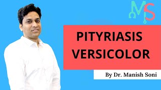 Pityriasis Versicolor By Dr Manish Soni | Dermatology screenshot 5