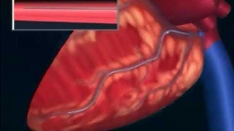 Animated implant of a CRT Cardiac Resynchronization or Bi Ventricular Device