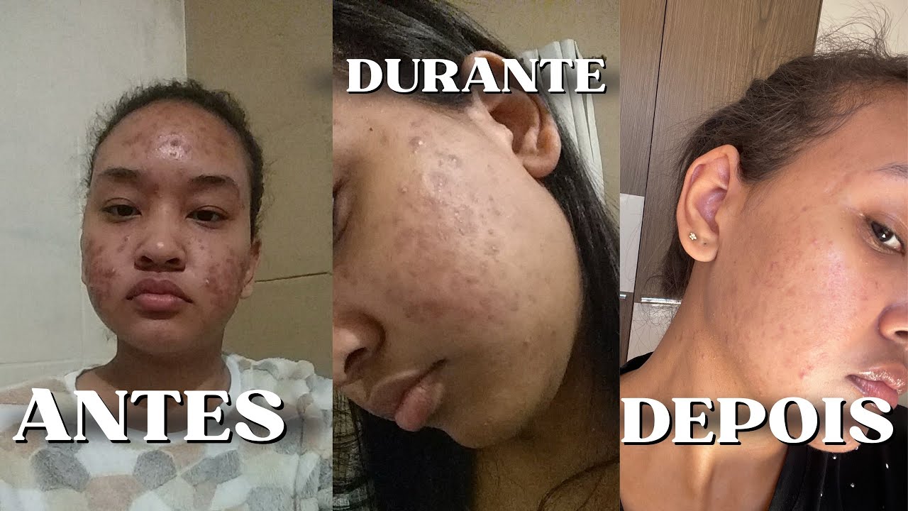 Por que sua acne nunca melhora? Descobri depois de 6 anos 😱