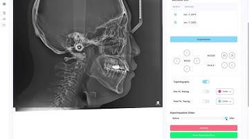 WebCeph: Automated Cephalo Tracing Superimposition #인공지능치아교정 #자동중첩 #웹셉