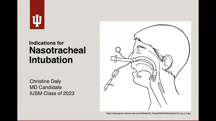Nasostracheal Intubation by Christine Daly, MD Can...
