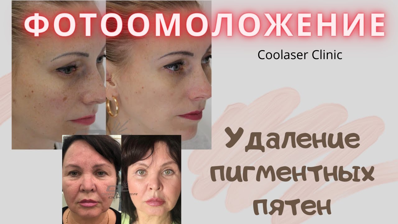 Как избавиться от пигментных пятен на лице? - Coolaser Clinic