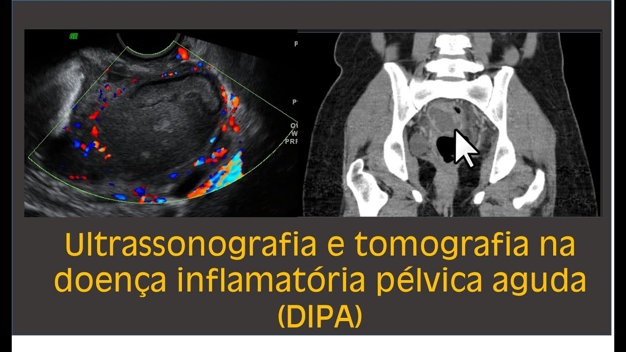 Ultrassonografia pélvica