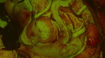 AVM visualized with FL560 fluorescence